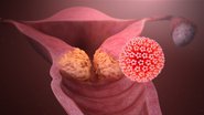 Папіломавірус і шийка матки